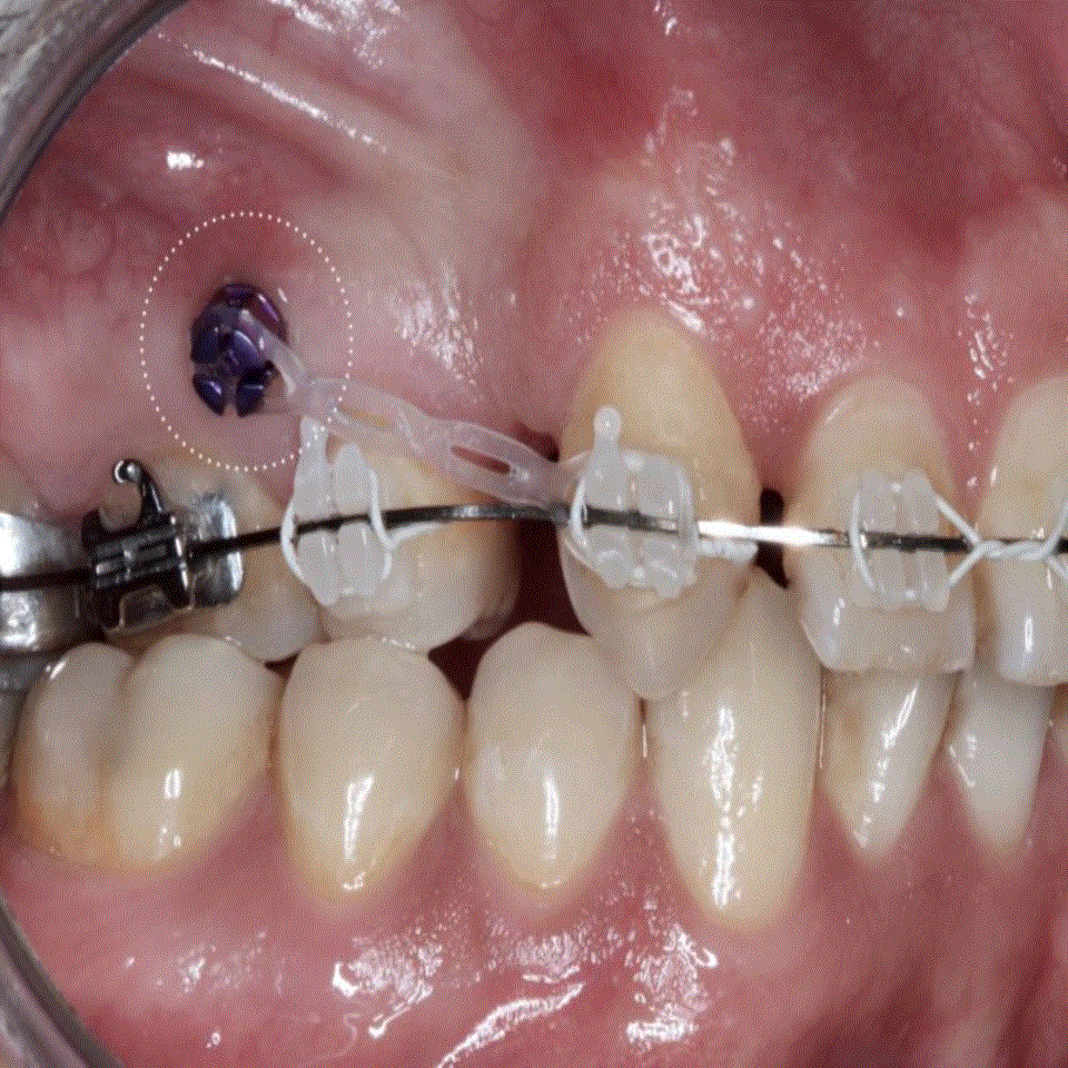 Mini Vidalar, Ortodontik Mini İmplantlar Nedir?